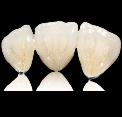 購入 パーソナライズ可能な半宝石クラウンまたは橋 宝石合金クラウンと橋 online manufacture