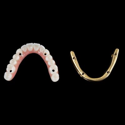 購入 チタンバー付きハイブリッド歯入れ online manufacture