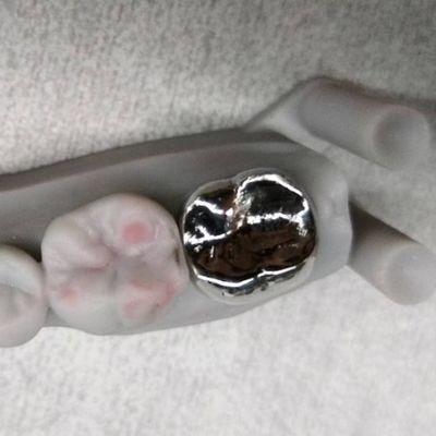 金属のクラウンと橋 高精度銀のクラウン