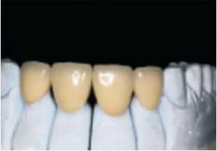 ホワイト 高貴貴重合金 クラウンとブリッジ 正確でカスタム